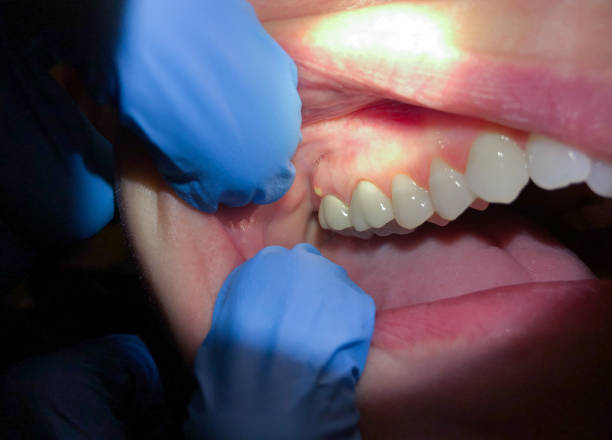 Best Emergency Dentist for Lost Fillings or Crowns in Burien, WA